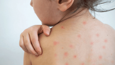 848 случаев заболевания корью зарегистрировано в Мангистау