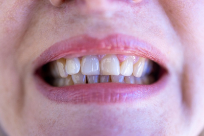 Виниры наполовину: жительница ВКО осталась без нижнего ряда "зубов"